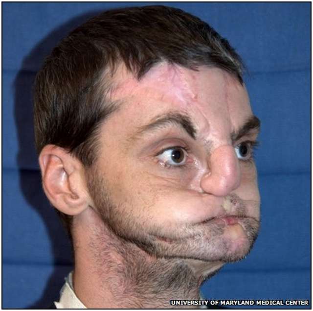Extensive-Face-Transplant-1