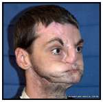 The Most Extensive Face Transplant in History