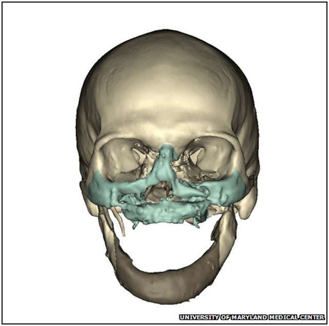 Extensive-Face-Transplant-2