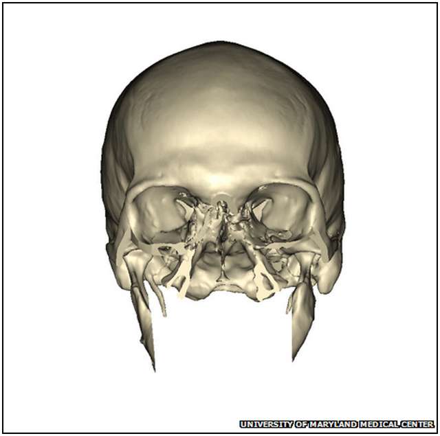 Extensive-Face-Transplant-3