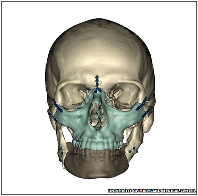 Extensive-Face-Transplant-4