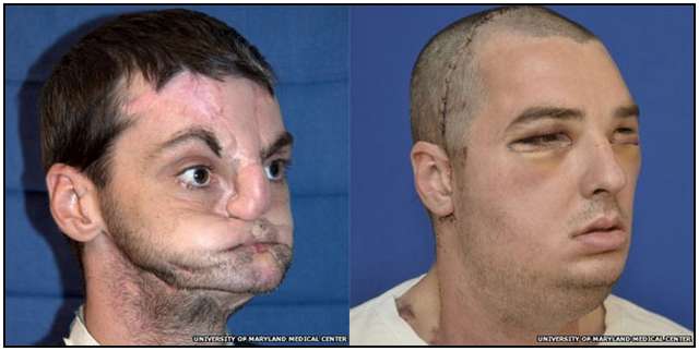 The Most Extensive Face Transplant in History